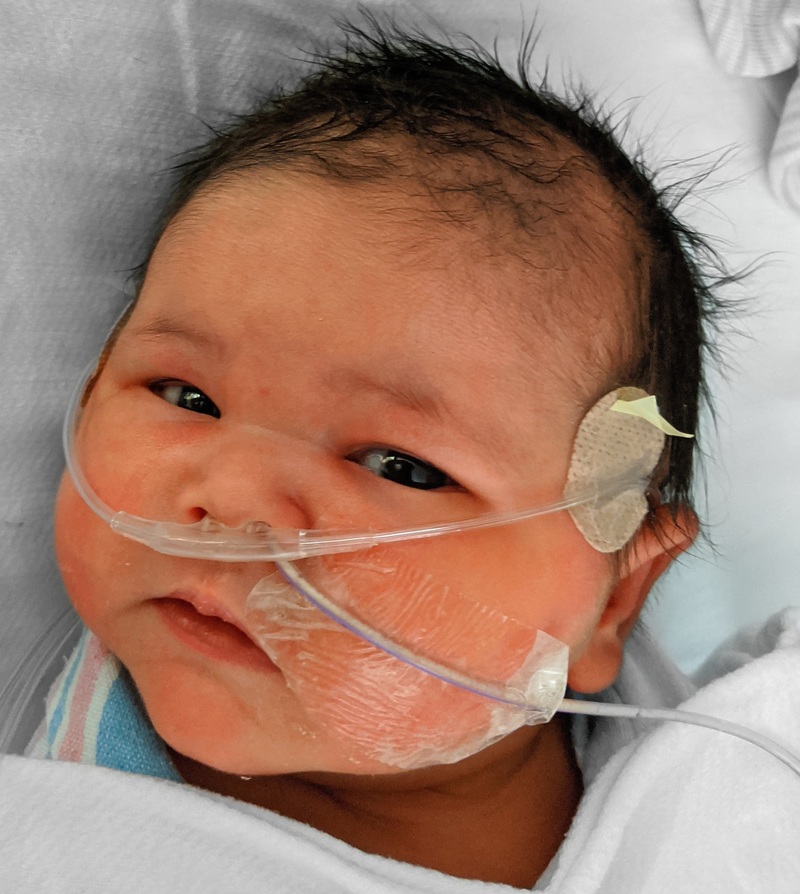 Aug 22: Fei Fei is on oxygen and has a feeding tube. She had since had the feeding tube removed.