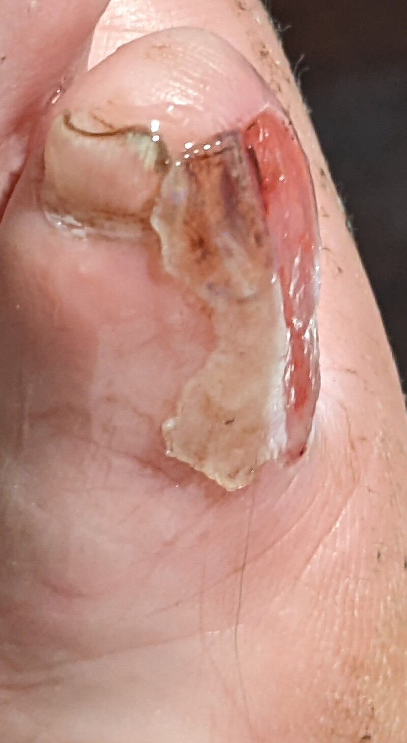The toe, or what is left of it.