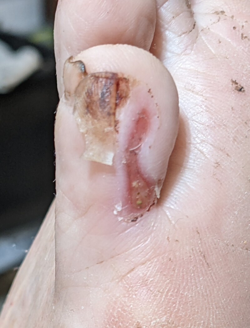 Jun8 Lois's toe is looking better. The skin that was ripped off is getting replaced by new skin.