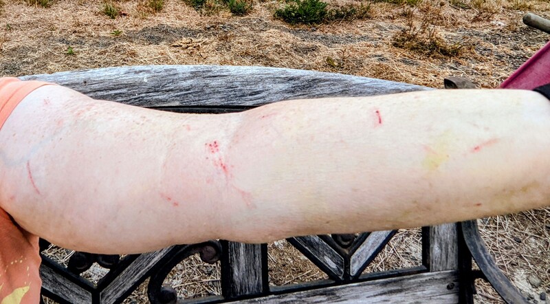 Lois's scratches after moving cattle panels and putting up the vines into the panels.