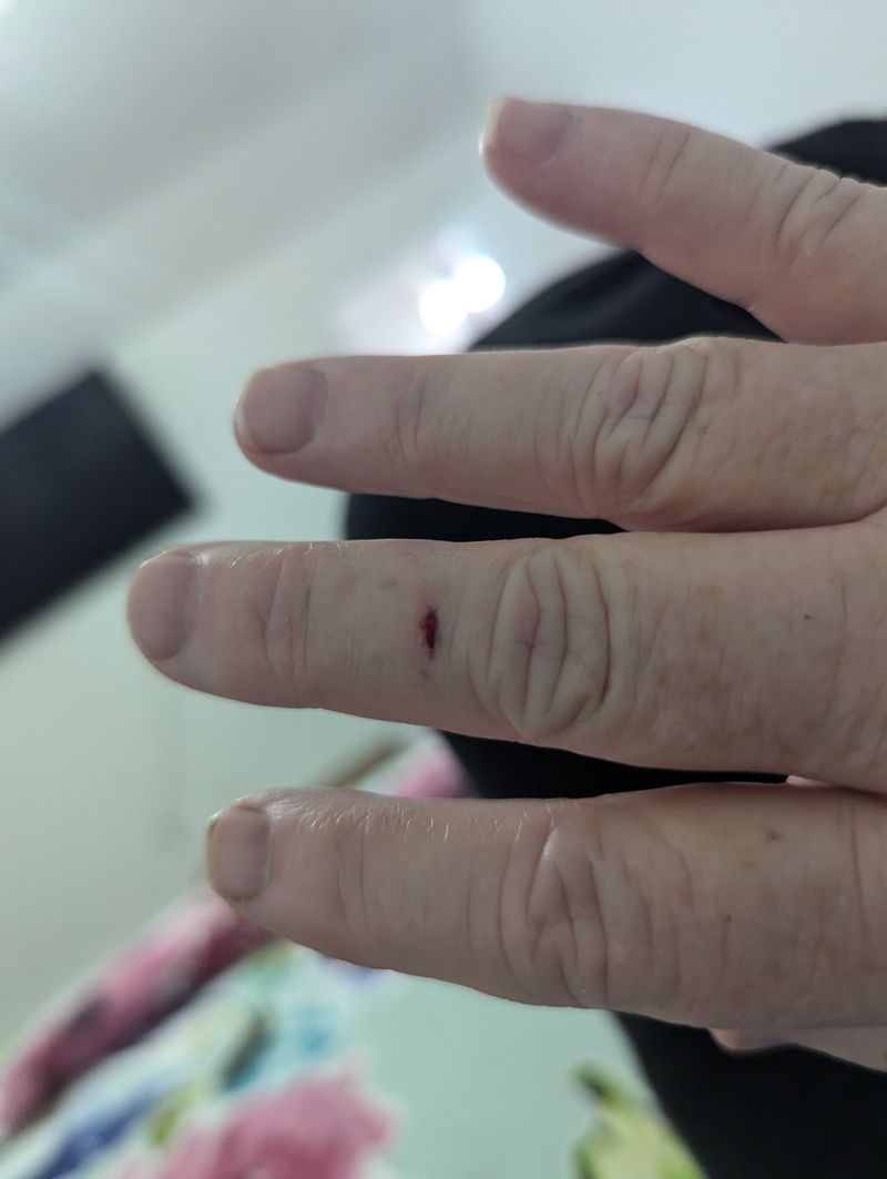 Results of picking up a recliner the wrong way. It cut straight down to the bone and didn't bleed, which was weird, but hurt a lot. Fortunately I don't think it cut the vine.