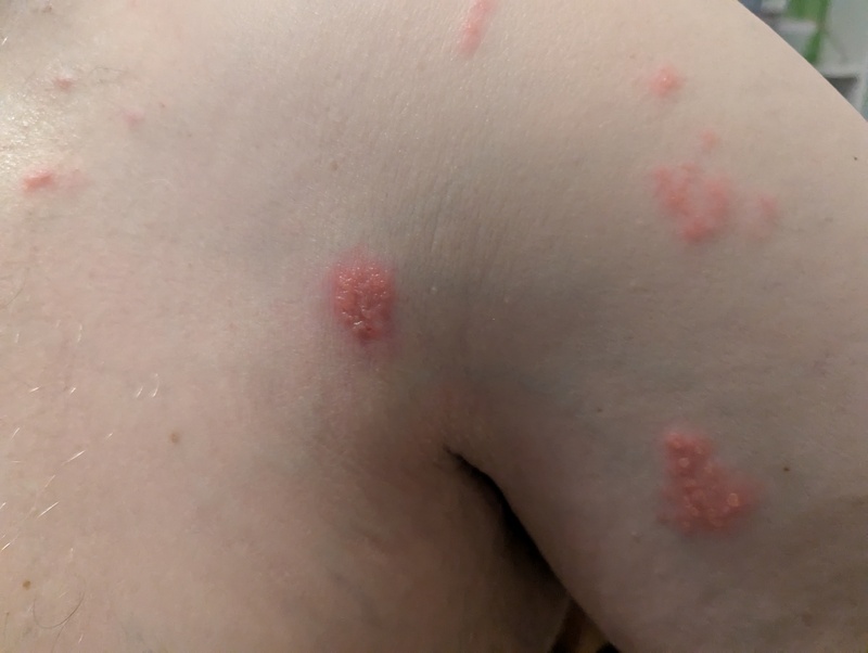 Don Shingles day #0.  Oct12.  This is the first day we noticed the rash.  Lots of little blisters.  We thought it might be Impetigo at this point.  Later we concluded it was Shingles.