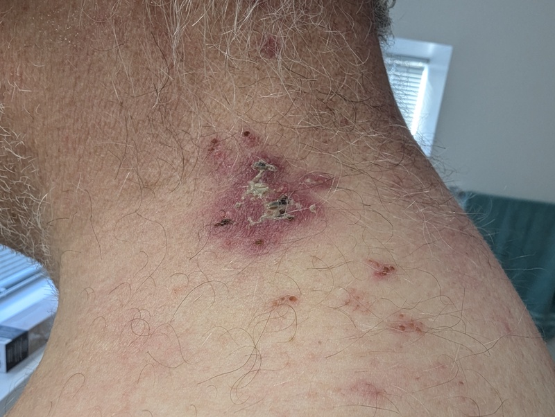 Don Shingles day #9.  Oct21.  After h2o2.  Mostly scabbed over.