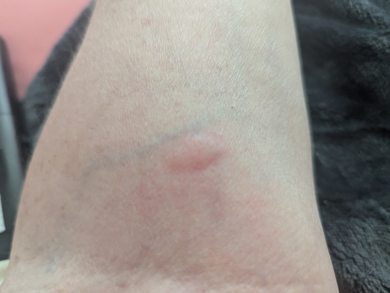 I cut leaves out of the yellow zucchini since I have had trouble with them. I instantly got bites all over my arms that reacted quickly.
