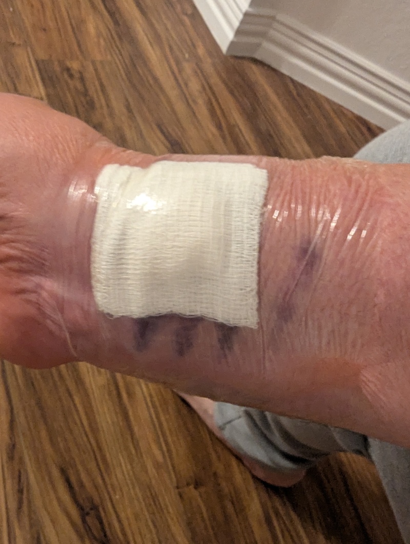 Sep12 Bruise after about a day.