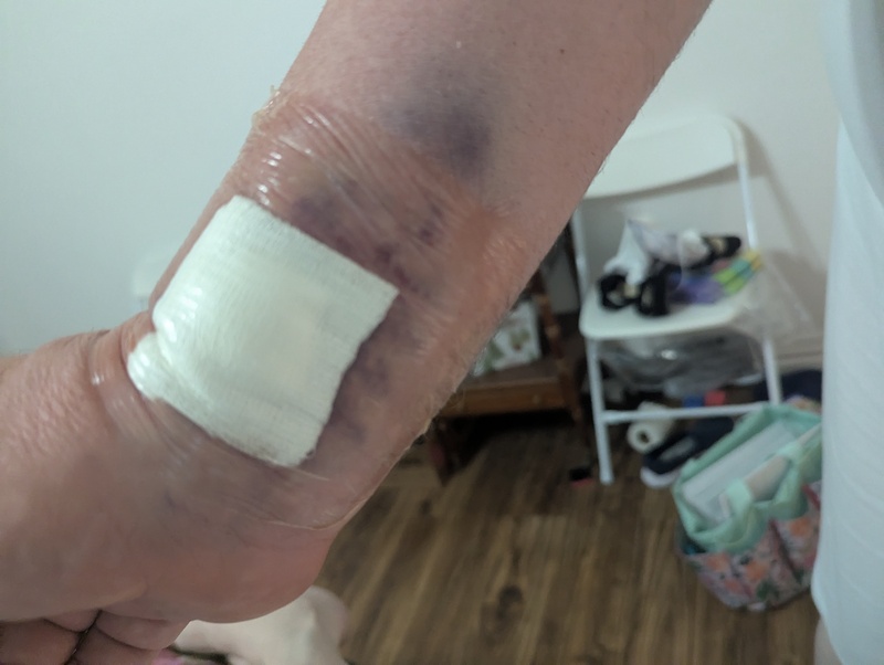 Sep13 Bruise after about two days.