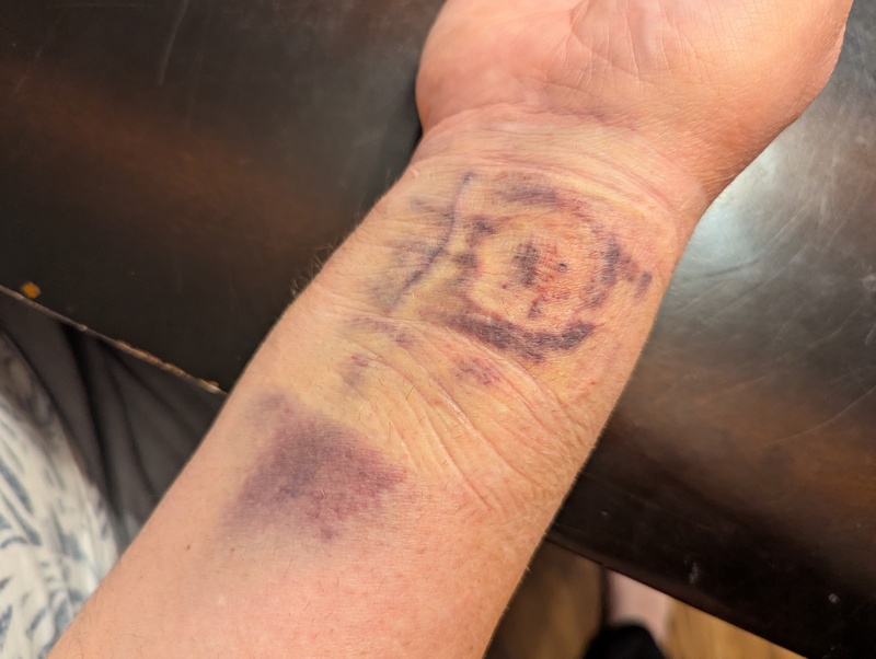 Sep14 When the bandage came off yesterday.