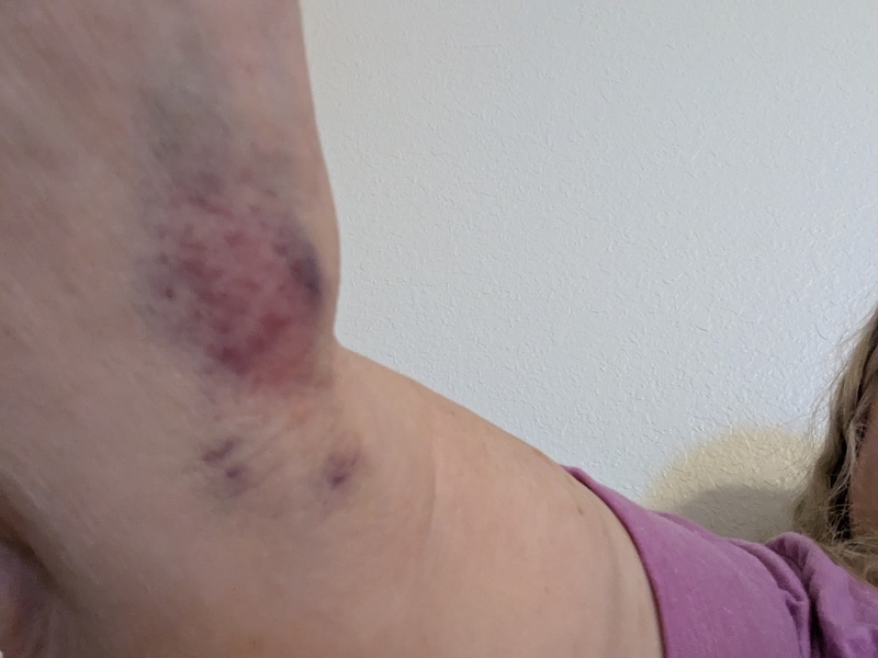 Lois's bruises after her endoscopy. It did feel like she was digging around.