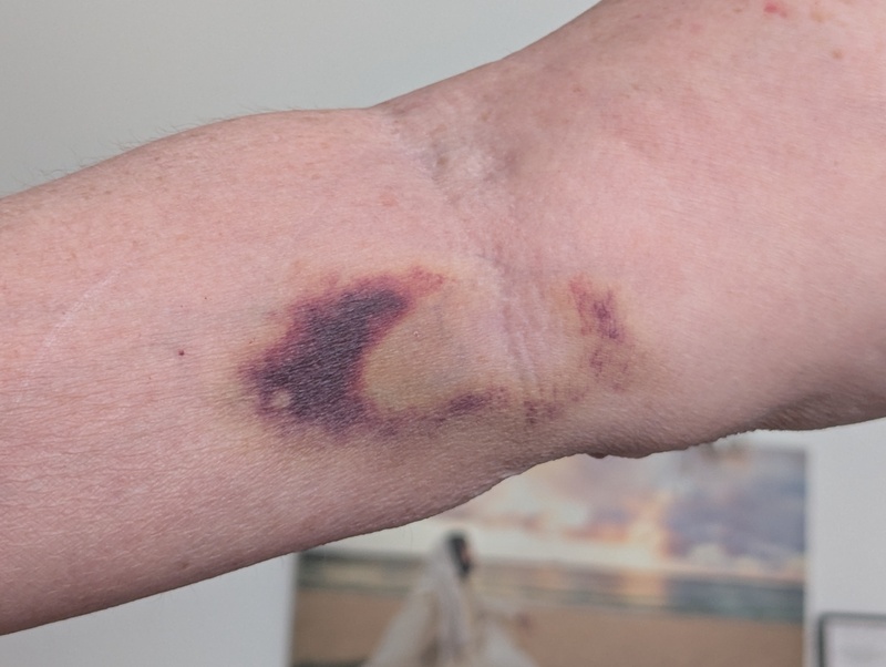 I still have a bruise from my IV.