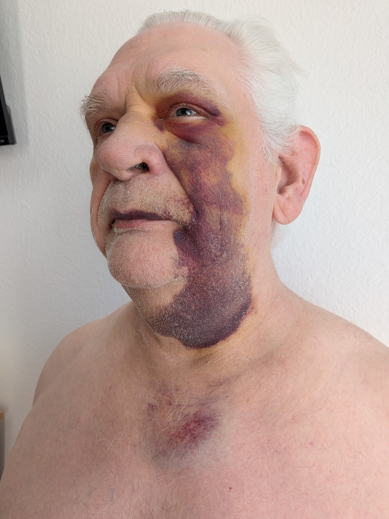 Fri13 noon the bruises are below my neck. The top is turning yellow.
