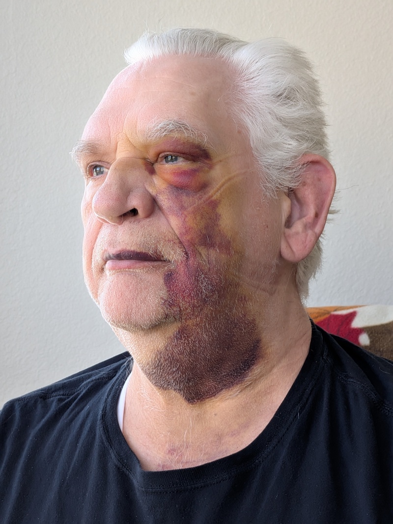 Sat14 11am with lines from my CPAP mask.