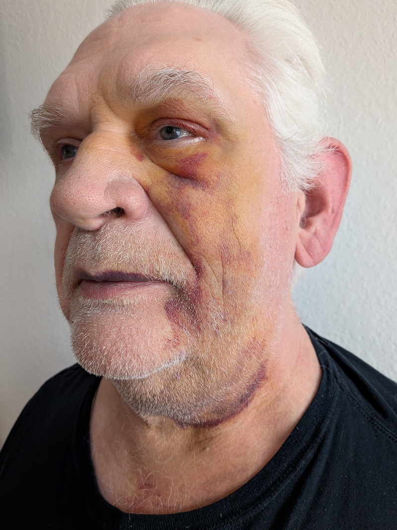 Sun15 2pm, the bruising shockingly went way down. Lots of yellow.