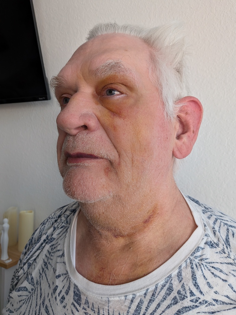 Tue @10 Bruising update.