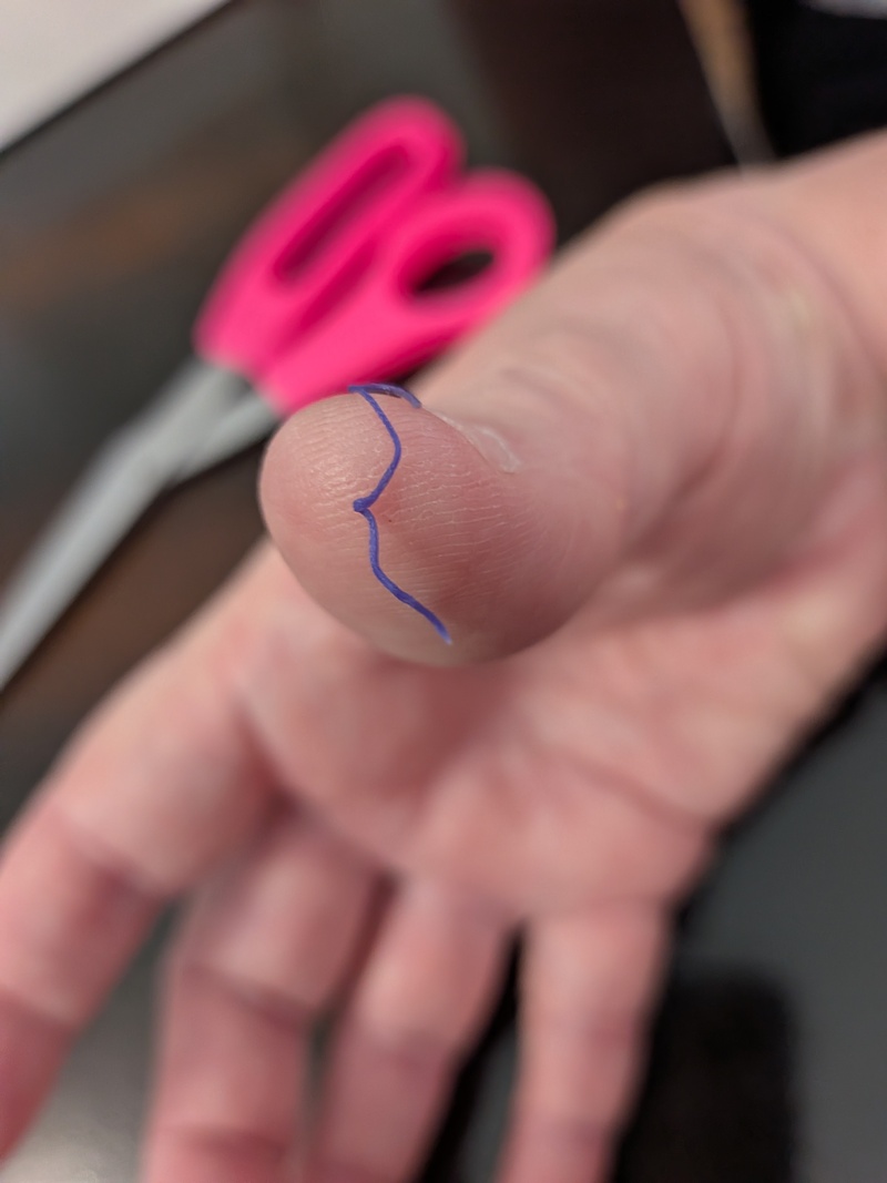 First stitch came out of Don's gums.