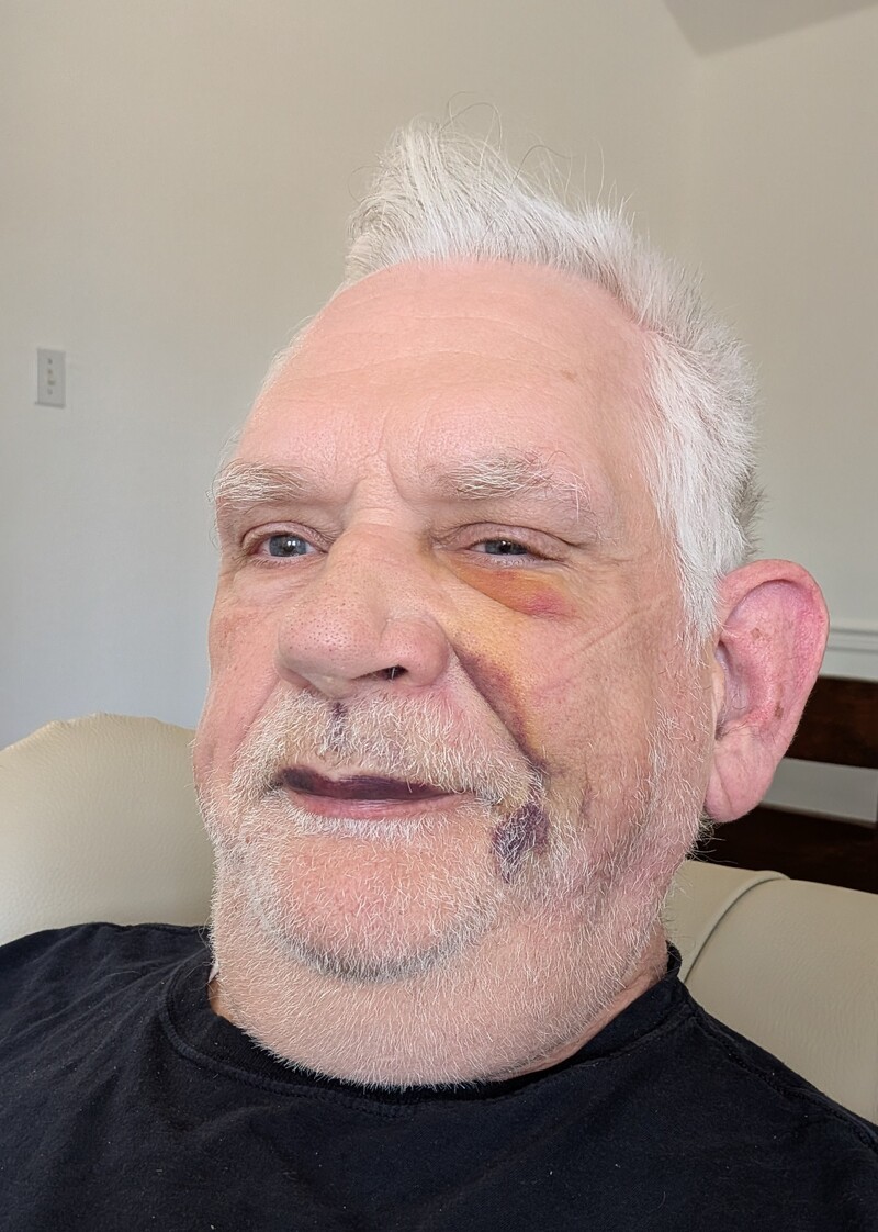 Don reprising his role as Phantom of the Opera after recent dental work.